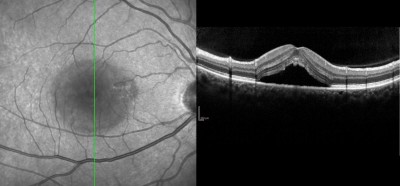 OCT in Corioretinopatia sierosa centrale